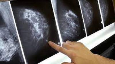 Aprovado PL que institui diretrizes para Exame de Mamografia Móvel
