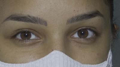 Cai procura por exames para diagnóstico de glaucoma na pandemia
