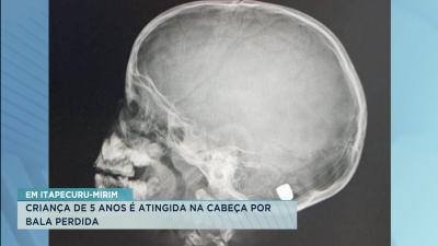 Itapecuru-Mirim: criança de 5 anos é baleada na cabeça