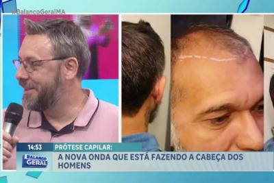 Vem Comigo: conheça a prótese capilar, tendência estética para disfarçar a calvície 