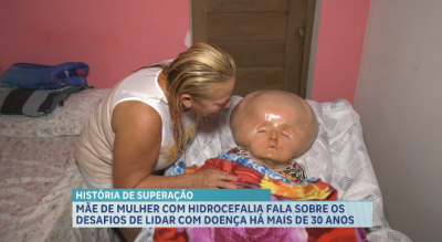 Mãe de mulher com hidrocefalia fala sobre os desafios de lidar com a doença há mais de 30 anos